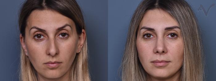 Before & After Rhinoplasty Case 408 Front View in Los Angeles, CA