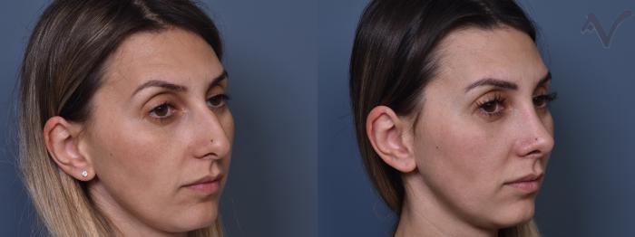 Before & After Rhinoplasty Case 408 Right Oblique View in Los Angeles, CA