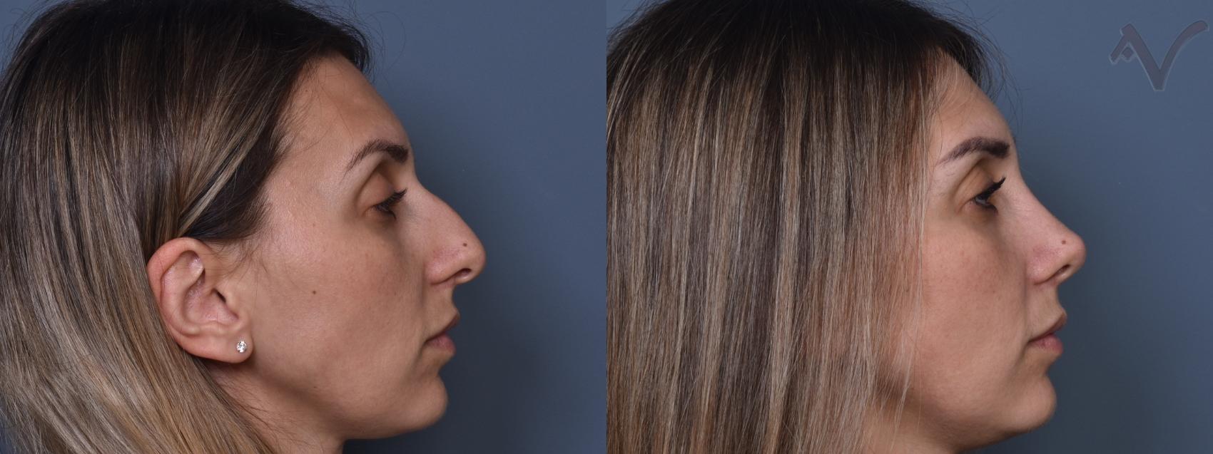 Before & After Rhinoplasty Case 408 Right Side View in Los Angeles, CA