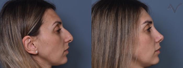 Before & After Rhinoplasty Case 408 Right Side View in Los Angeles, CA