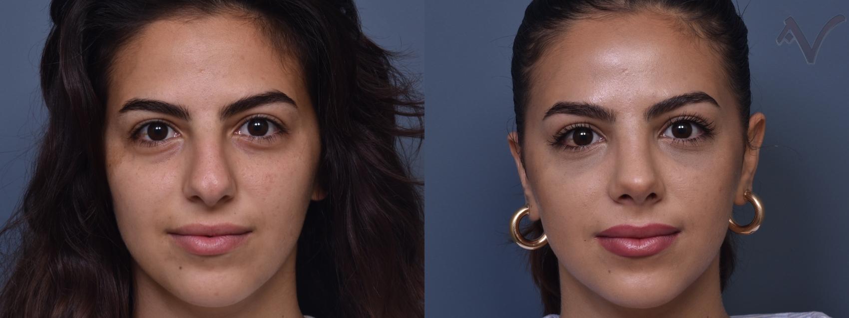 Before & After Rhinoplasty Case 409 Front View in Los Angeles, CA