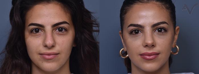 Before & After Rhinoplasty Case 409 Front View in Los Angeles, CA