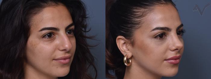 Before & After Rhinoplasty Case 409 Right Oblique View in Los Angeles, CA