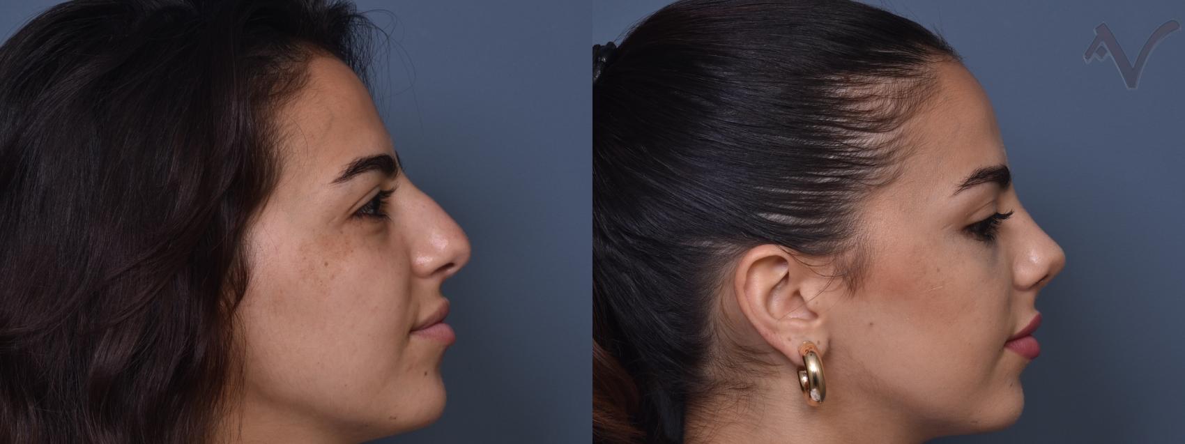 Before & After Rhinoplasty Case 409 Right Side View in Los Angeles, CA