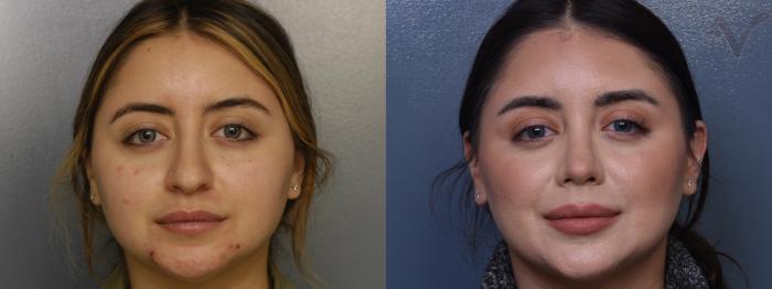 Before & After Rhinoplasty Case 412 Front View in Los Angeles, CA