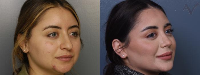 Before & After Rhinoplasty Case 412 Right Oblique View in Los Angeles, CA