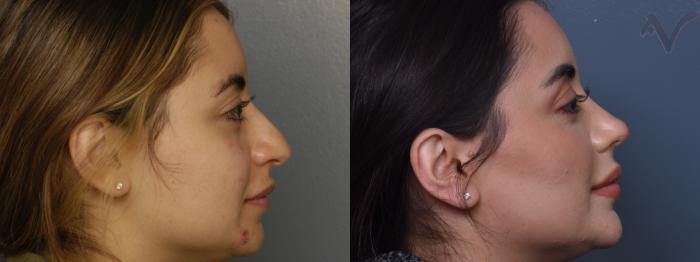 Before & After Rhinoplasty Case 412 Right Side View in Los Angeles, CA