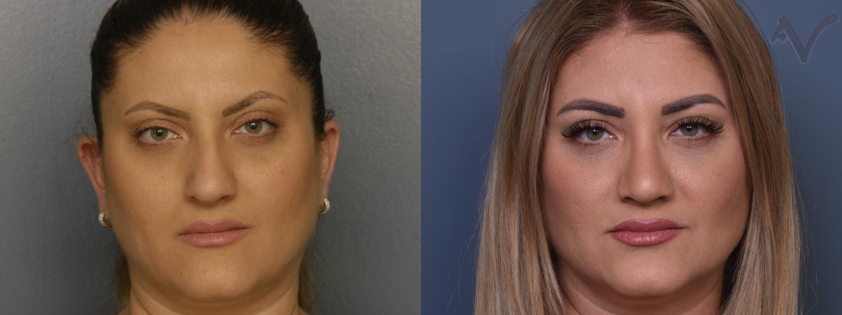 Before & After Rhinoplasty Case 413 Front View in Los Angeles, CA