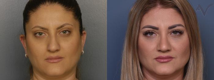 Before & After Rhinoplasty Case 413 Front View in Los Angeles, CA