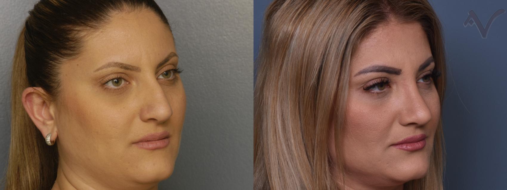 Before & After Rhinoplasty Case 413 Right Oblique View in Los Angeles, CA