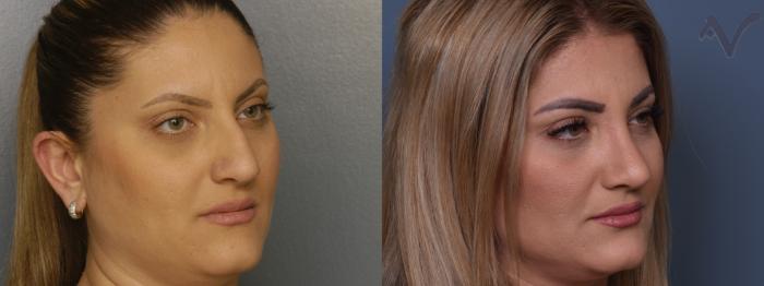 Before & After Rhinoplasty Case 413 Right Oblique View in Los Angeles, CA