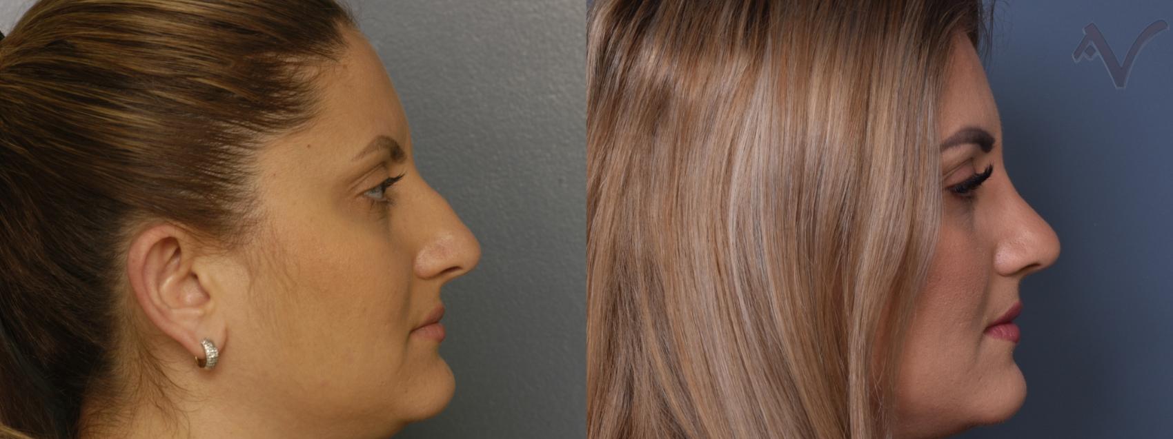 Before & After Rhinoplasty Case 413 Right Side View in Los Angeles, CA