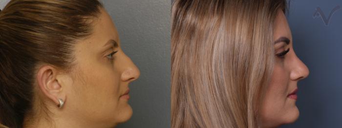 Before & After Rhinoplasty Case 413 Right Side View in Los Angeles, CA