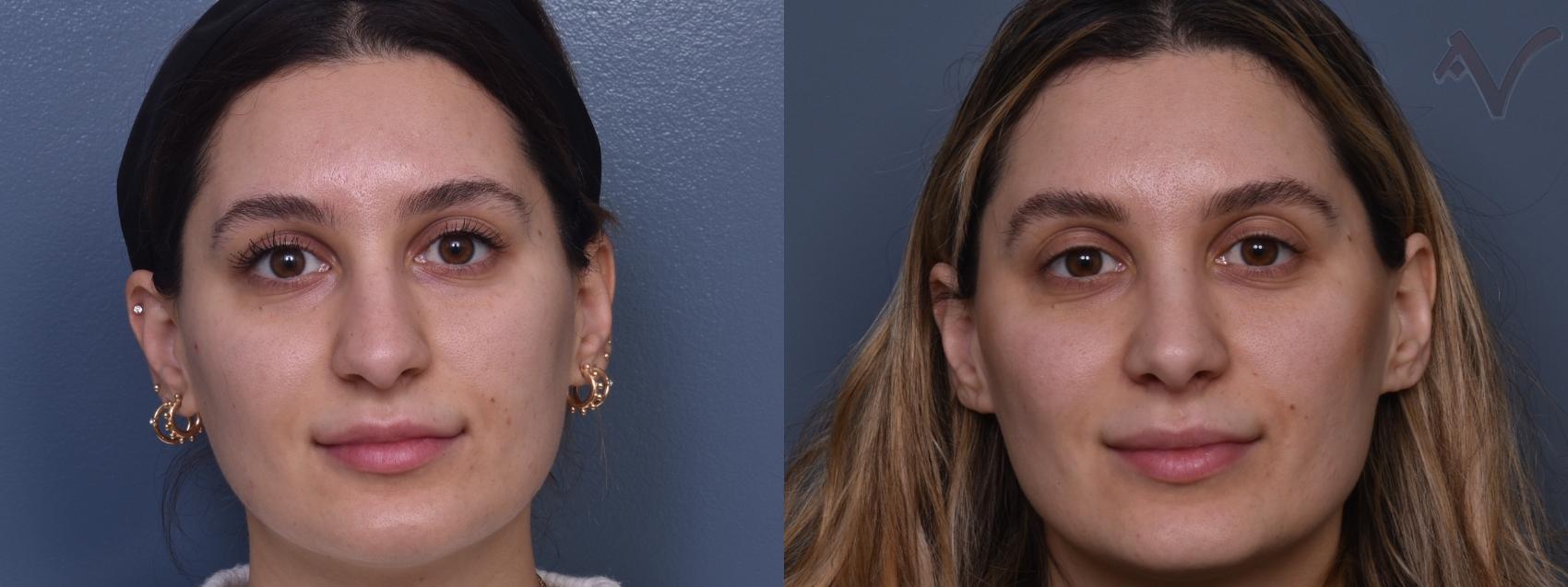 Before & After Rhinoplasty Case 414 Front View in Los Angeles, CA