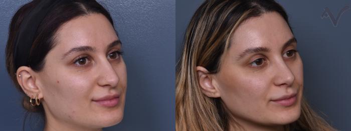 Before & After Rhinoplasty Case 414 Right Oblique View in Los Angeles, CA