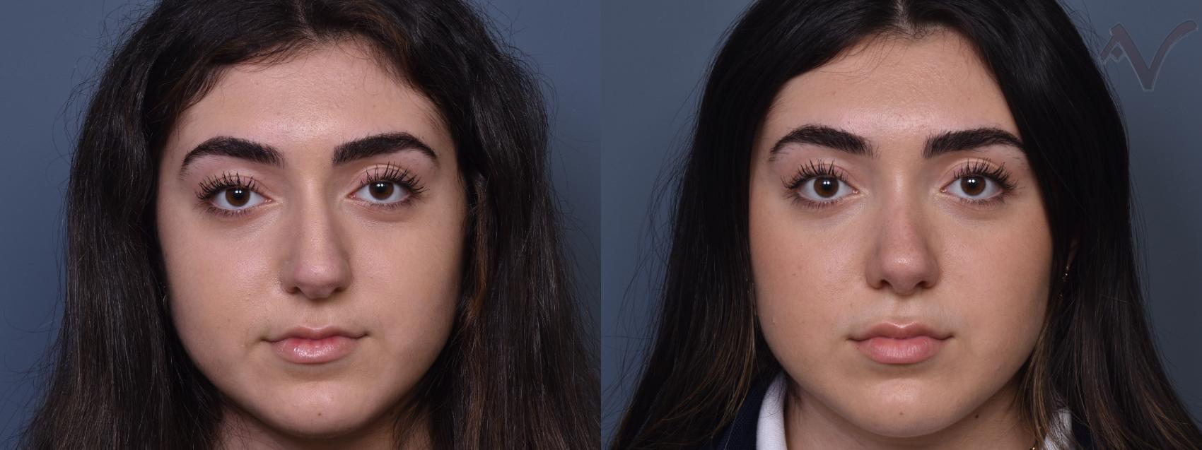 Before & After Rhinoplasty Case 415 Front View in Los Angeles, CA