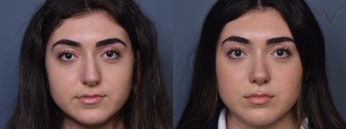 Before & After Rhinoplasty Case 415 Front View in Los Angeles, CA