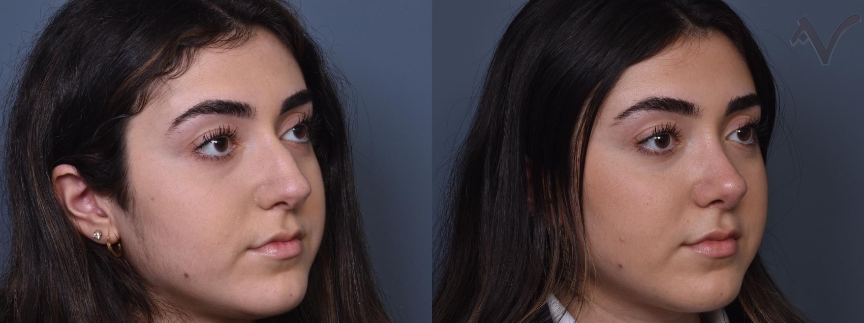 Before & After Rhinoplasty Case 415 Right Oblique View in Los Angeles, CA