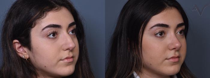 Before & After Rhinoplasty Case 415 Right Oblique View in Los Angeles, CA
