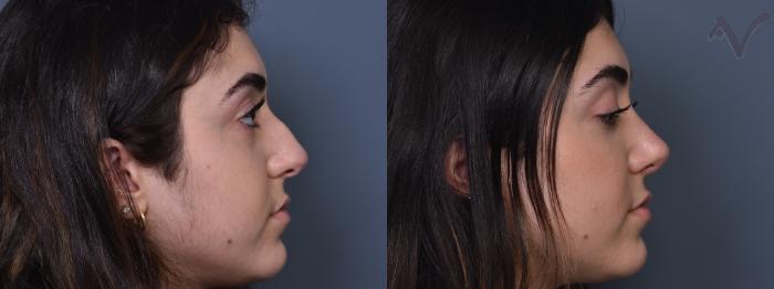 Before & After Rhinoplasty Case 415 Right Side View in Los Angeles, CA
