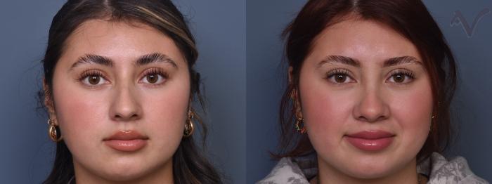 Before & After Rhinoplasty Case 416 Front View in Los Angeles, CA