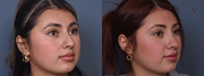 Before & After Rhinoplasty Case 416 Right Oblique View in Los Angeles, CA