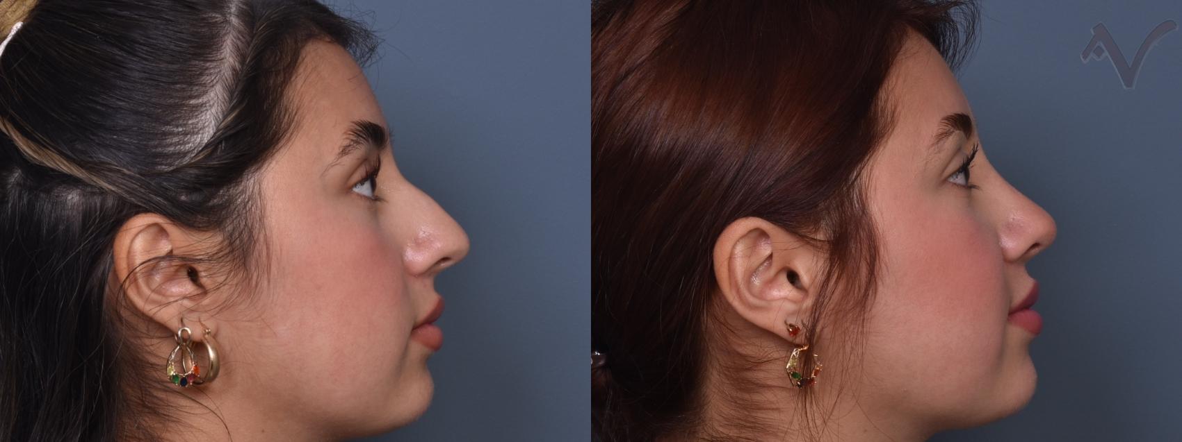 Before & After Rhinoplasty Case 416 Right Side View in Los Angeles, CA
