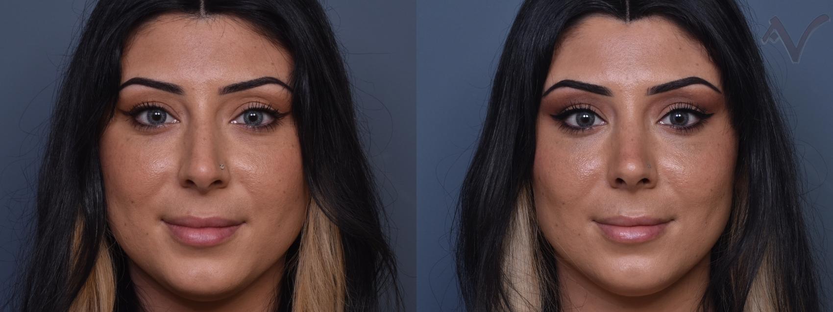 Before & After Rhinoplasty Case 420 Front View in Los Angeles, CA