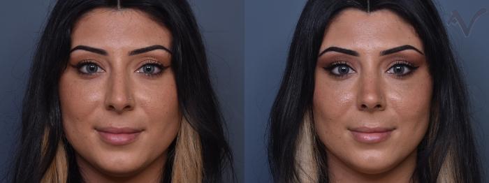 Before & After Rhinoplasty Case 420 Front View in Los Angeles, CA
