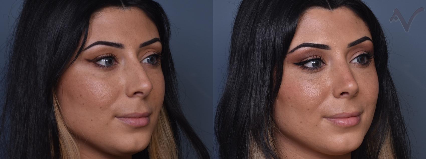 Before & After Rhinoplasty Case 420 Right Oblique View in Los Angeles, CA