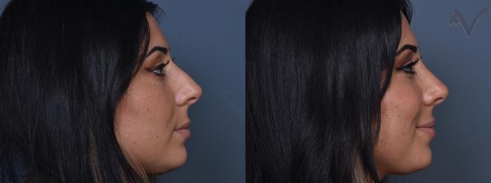 Before & After Rhinoplasty Case 420 Right Side View in Los Angeles, CA
