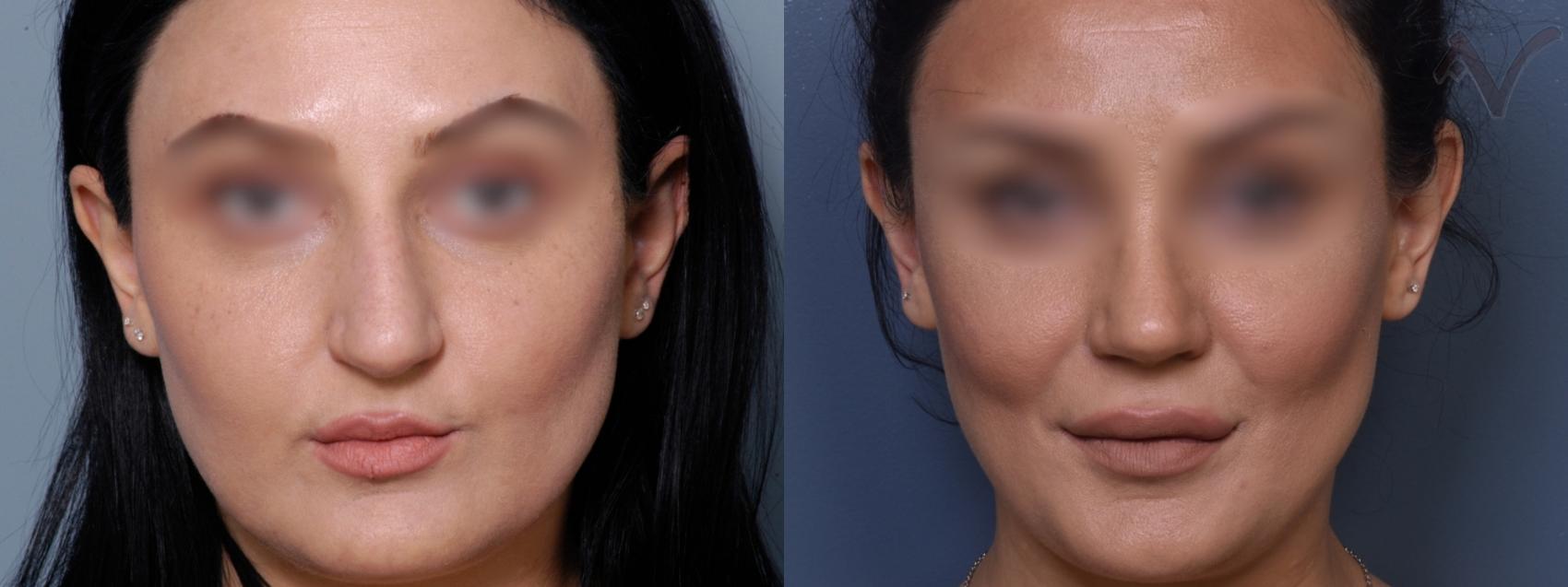 Before & After Rhinoplasty Case 423 Front View in Los Angeles, CA