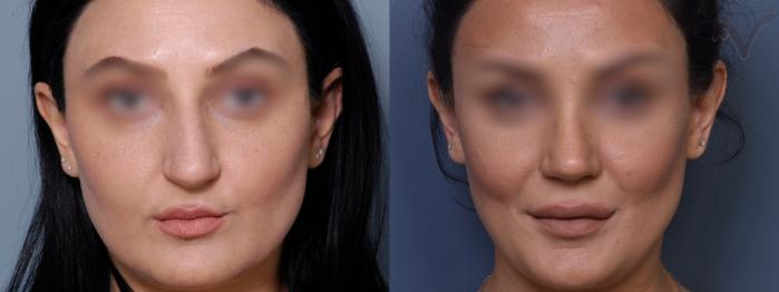Before & After Rhinoplasty Case 423 Front View in Los Angeles, CA