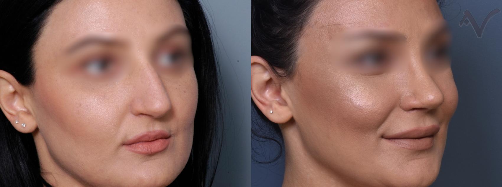 Before & After Rhinoplasty Case 423 Right Oblique View in Los Angeles, CA