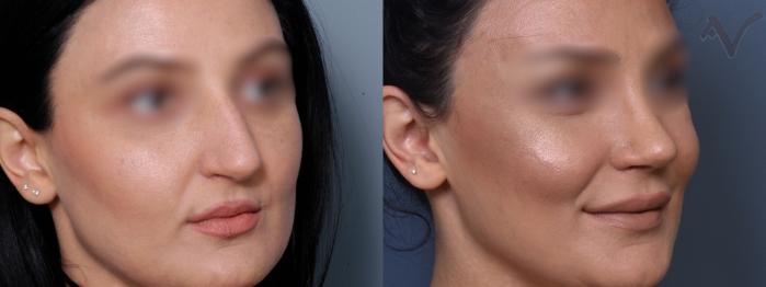 Before & After Rhinoplasty Case 423 Right Oblique View in Los Angeles, CA