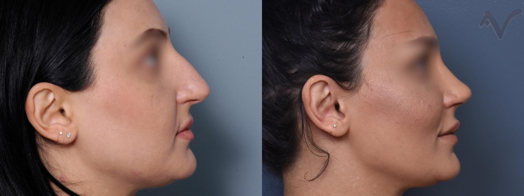 Before & After Rhinoplasty Case 423 Right Side View in Los Angeles, CA
