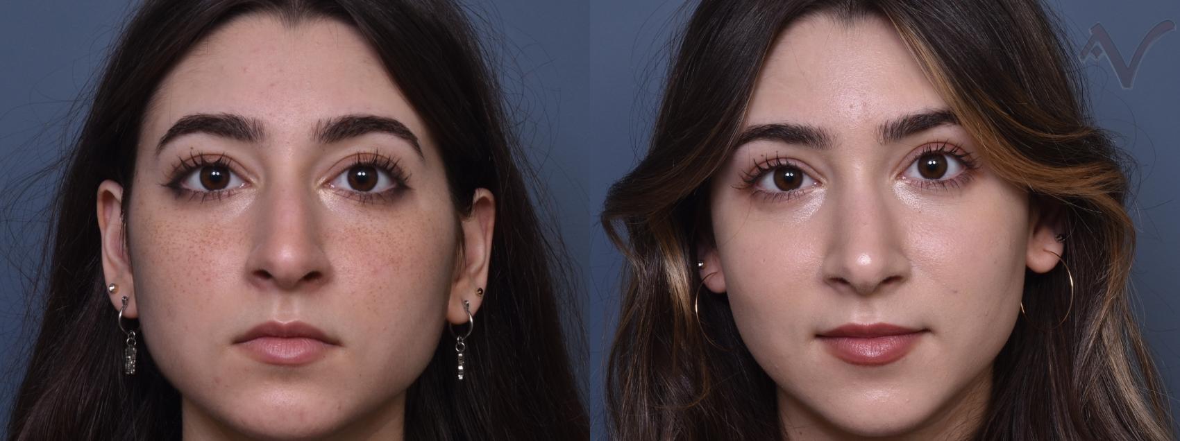 Before & After Rhinoplasty Case 424 Front View in Los Angeles, CA