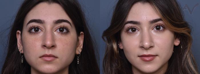 Before & After Rhinoplasty Case 424 Front View in Los Angeles, CA