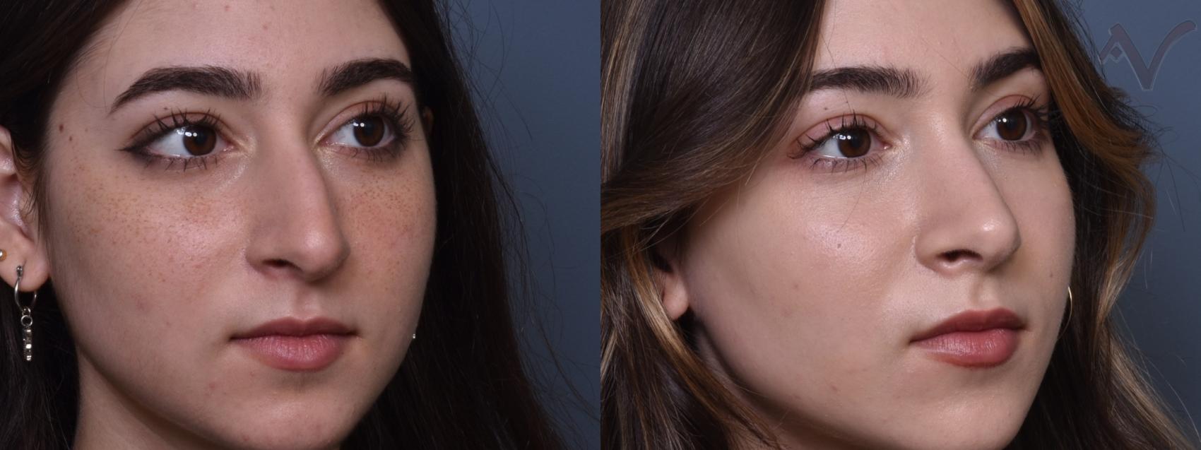 Before & After Rhinoplasty Case 424 Right Oblique View in Los Angeles, CA
