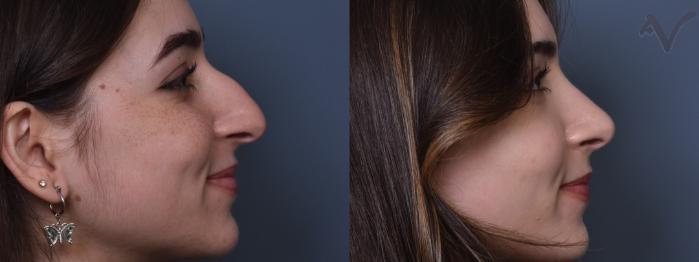 Before & After Rhinoplasty Case 424 Right Side View in Los Angeles, CA
