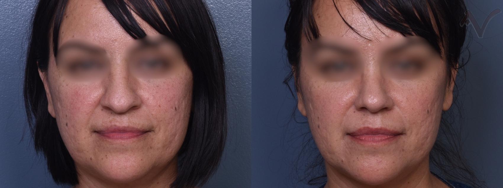 Before & After Rhinoplasty Case 425 Front View in Los Angeles, CA