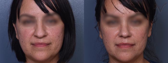 Before & After Rhinoplasty Case 425 Front View in Los Angeles, CA