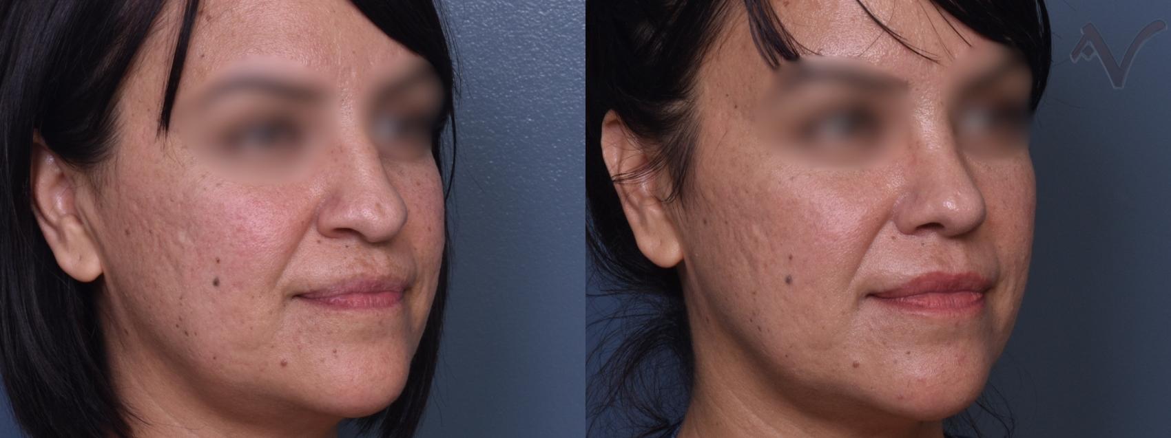 Before & After Rhinoplasty Case 425 Right Oblique View in Los Angeles, CA