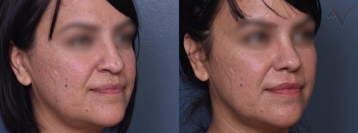 Before & After Rhinoplasty Case 425 Right Oblique View in Los Angeles, CA