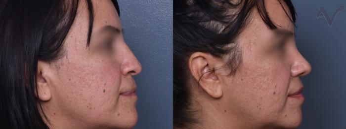Before & After Rhinoplasty Case 425 Right Side View in Los Angeles, CA