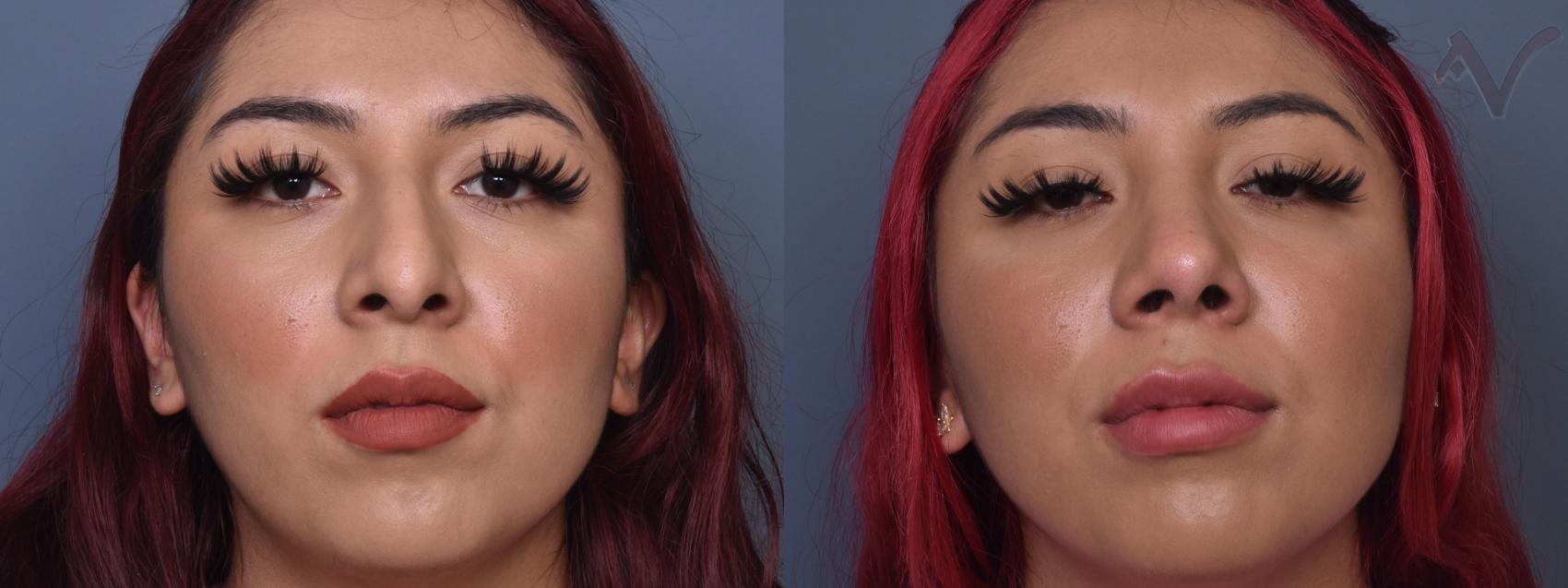 Before & After Rhinoplasty Case 426 Front View in Los Angeles, CA