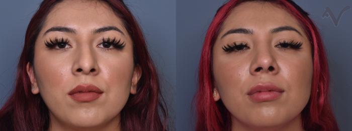 Before & After Rhinoplasty Case 426 Front View in Los Angeles, CA