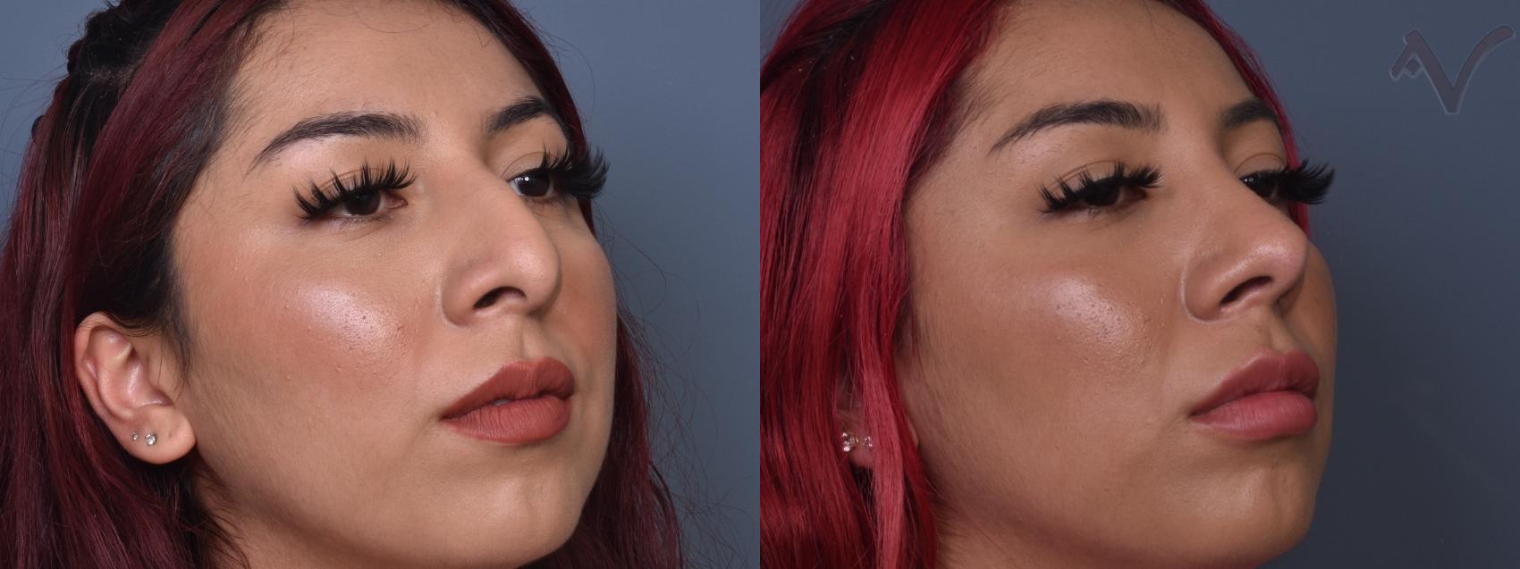 Before & After Rhinoplasty Case 426 Right Oblique View in Los Angeles, CA