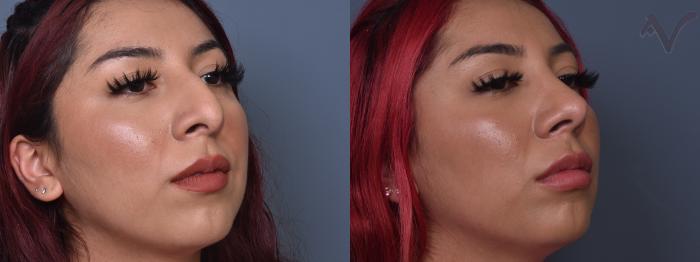 Before & After Rhinoplasty Case 426 Right Oblique View in Los Angeles, CA