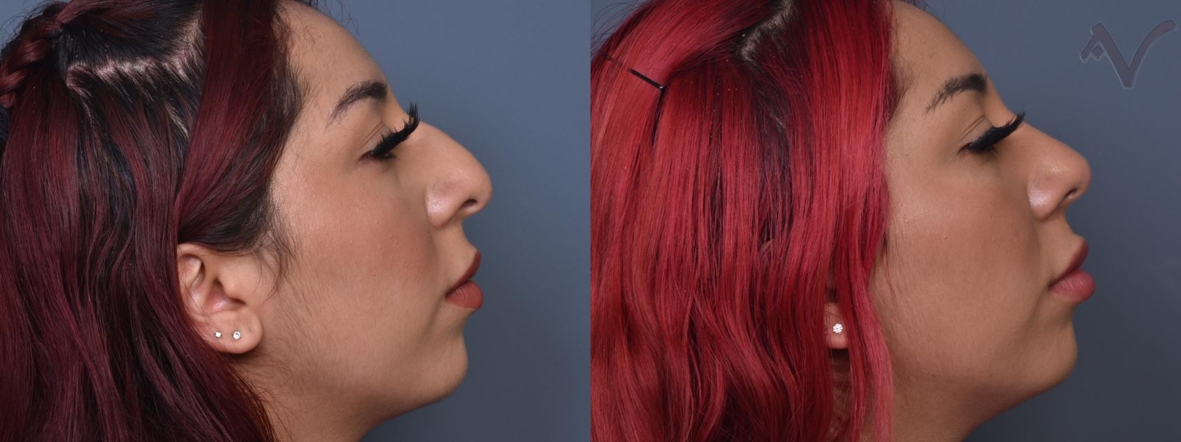 Before & After Rhinoplasty Case 426 Right Side View in Los Angeles, CA